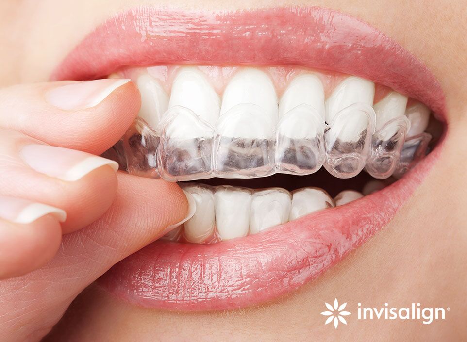 invisalign gonzález baquero - caso de éxito marketing madrid